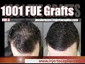 1001FUE Grafts.MPB NW II.Combined medical-surgical treatment.5 months. Injertocapilar.com.2574/2020