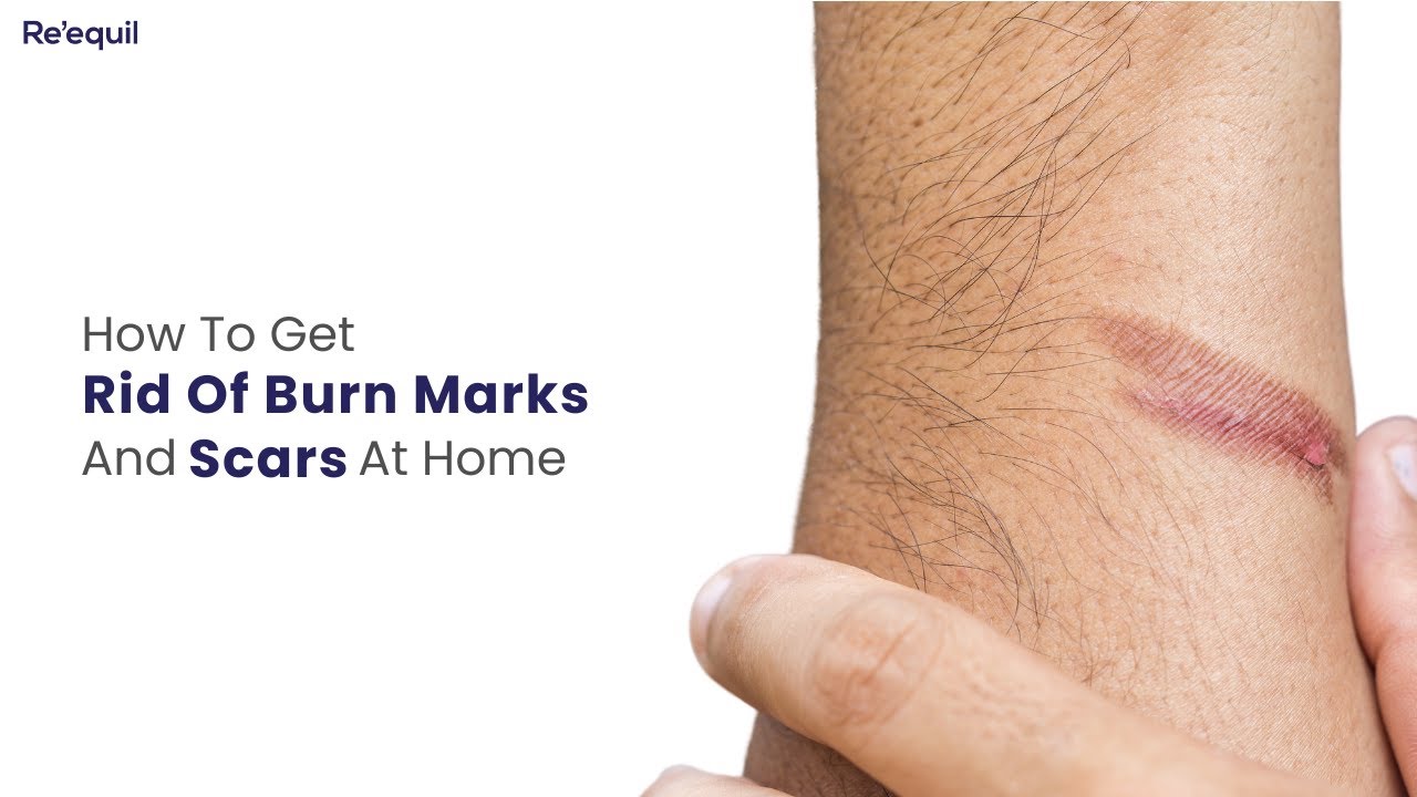 How To Get Rid Of Burn Marks And Scars At Home - YouTube