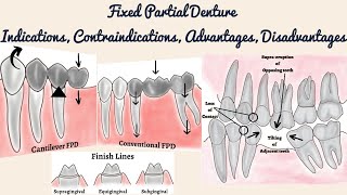 Fixed Partial Denture - Indications, Contraindications, Advantages and Disadvantages/ FPD Overview