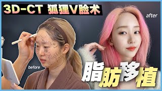 【韩国爱她】最近最火的面部吸脂医院 爱她! 狐狸V脸术 真人VLOG（李汉正代表院长）