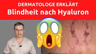 BLINDHEIT DURCH HYALURON-FILLER. DAS MÜSSEN SIE VOR EINER BEHANDLUNG WISSEN. DERMATOLOGE DR. KASTEN