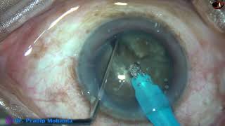 A hard cataract managed today - minimally edited : Pradip Mohanta, 1st Sept 2020