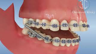 Üst Çene İleri İtimli Kapanışın Sabit Apareylerle Ortodontik Tedavisi