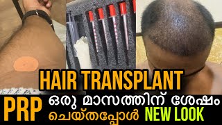 #hairtransplant ഒരു മാസത്തിന് ശേഷം ആദ്യത്തെ #prp ചെയ്തപ്പോൾ😊വന്ന മാറ്റങ്ങൾ #hairlosstreatment