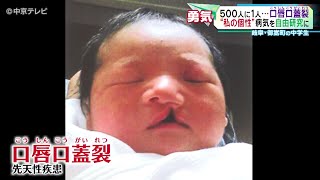 【“私の個性”病気を自由研究に】500人に１人の割合の病気「口唇口蓋裂(こうしんこうがいれつ)」　岐阜・御嵩町の中学生