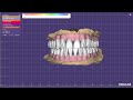 Full mouth designing in exocad elefsina for durable prosthesis in single piece implants - with error