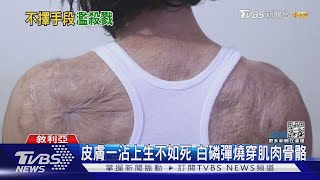 膚燒如剝洋蔥 俄疑用化武「白磷彈」 下一步恐爆核戰｜TVBS新聞