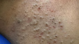 [ASMR] Daily Skincare Routine: Deep Cleansing Techniques for Blackheads and Acne