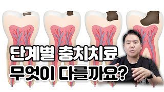 다같은 치료가 아니다! 단계에 따른 충치 치료를 알려드립니다