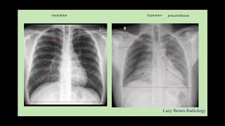 Body Cavities, abdominal divisions, and body habitus episode 3 #LazyBonesRadiology