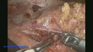 Robotic Revisional Surgery after Marginal Ulcer in Gastric Bypass