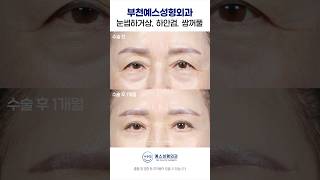 복합눈성형, 10년은 어려 보이는 마법 #Lowerblepharoplasty #Subbrowlifting