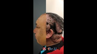 Dr. Bumpinator Terminates Acne Keloidalis Nuchae (Before and After)