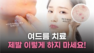 여드름으로 스트레스 받으신다면 꼭! 말씀 드리고 싶었던 주의사항 ⭐️ 나에게 맞는 치료법은 따로 있다?!