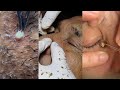 75+ Minutes Of ASMR Pimple Popping Video