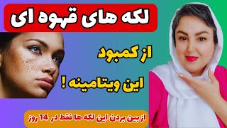 درمان قطعی لکه های قهوه ای و لکه های پیری پوست صورت و بدن