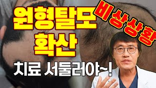 원형탈모 확산은 비상상황 치료 서둘러야~ (전두탈모 치료법)