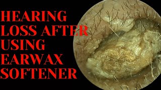 Hearing LOSS After Using Earwax Softener