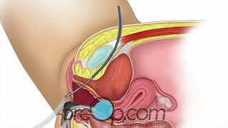 🔬 Revolutionary Mesh Sling Fix for Women's SUI: #StressUrinaryIncontinence #PreOp® Patient Education