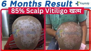 Vitiligo White spots on Scalp Treatment  | बच्चों में सफेद दाग - 85% Recovery in 6 Months | Kayakalp