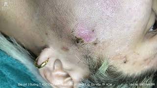 Big Cystic Acne Blackheads Extraction Blackheads \u0026 Milia, Whiteheads Removal Pimple Popping