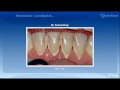 periodontitt