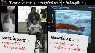 ศิริราช The Life [by Mahidol] ซีรีส์ x-ray ห้องตรวจ ตอน กระดูกสันหลังคด , ลิ่มเลือดอุดตัน