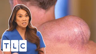 Dr Lee Surprised By Man’s MASSIVE Growth On His Shoulder & Back | Dr Pimple Popper