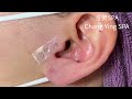 1顆耳朵黑頭 u00264顆小粉刺｜blackheads on ear removal 耳の角栓 耳掃除