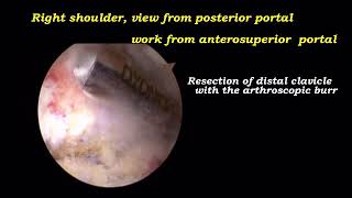 Arthroscopic Distal Clavicle and Medial Border of Acromion Resection for Symptomatic...