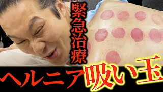 【吸い玉　整体】瘀血色最悪　キングの腰が壊れヘルニア様の腰痛を元町鍼灸師が総出で治療　吸い玉で瘀血を流す　かなりヤバいですね【東京銀座　横浜元町　鍼灸】