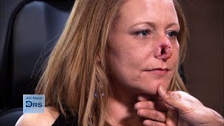 Woman Who Lost Half Her Nose: See How She's Doing Now