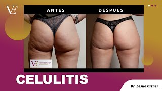 CELULITIS. EL EJOR TRATAMIENTO