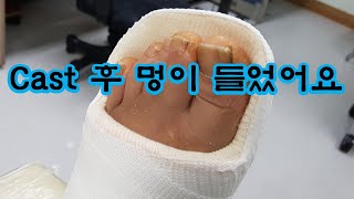 통깁스(cast) 후 멍이 들었어요.