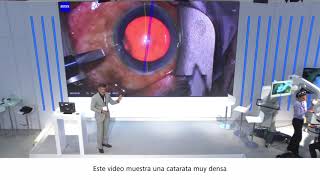 ZEISS miLOOP y ZEISS ARTEVO 800, caso catarata grado 4 - Dr. Sri Ganesh en la ESCRS 2019.