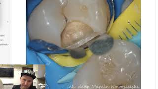 Dental MacGyver - Tips \u0026 Tricks e1 (en): Two wedges trick, missing teeth, wide interdental space.