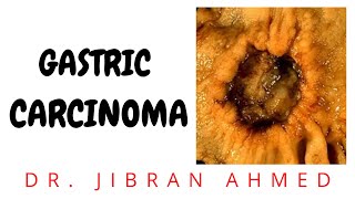 GASTRIC CARCINOMA II GIT II ROBBINS 10TH E II PATHOLOGY LECTURES II @DrJIBRANAHMED