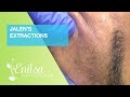 Jalen’s Extractions