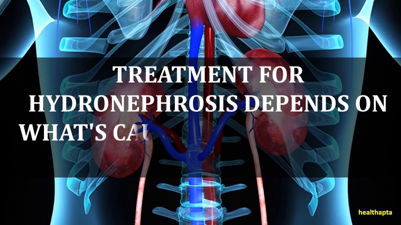 TREATMENT OF HYDRONEPHROSIS - YouTube