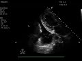 pleural effusion versus pericardial effusion on ultrasound imaging