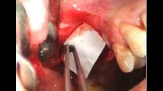 Sinus Lift with Piezotome 1