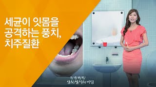 세균이 잇몸을 공격하는 풍치, 치주질환 - (20120714_421회 방송)_노년의 건강을 위협한다. 잇몸병, 치주질환