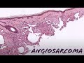 Angiosarcoma under the microscope (explained in 5 minutes) pathology dermpath dermatology