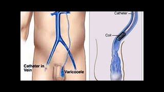 VARICOCELE/Infertility