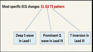 Acute Pulmonary Embolism |ECG Changes | S1Q3T3 |RBBB |Sinus Tachycardia | ECG Series| Mightymedicoz