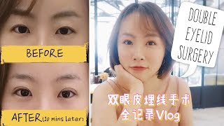 本人，终于去做双眼皮埋线啦！！！Double Eyelid Surgery丨Yeah Stacy