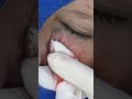 Cyst Under Patient’s Eye | Dr. Pimple Popper