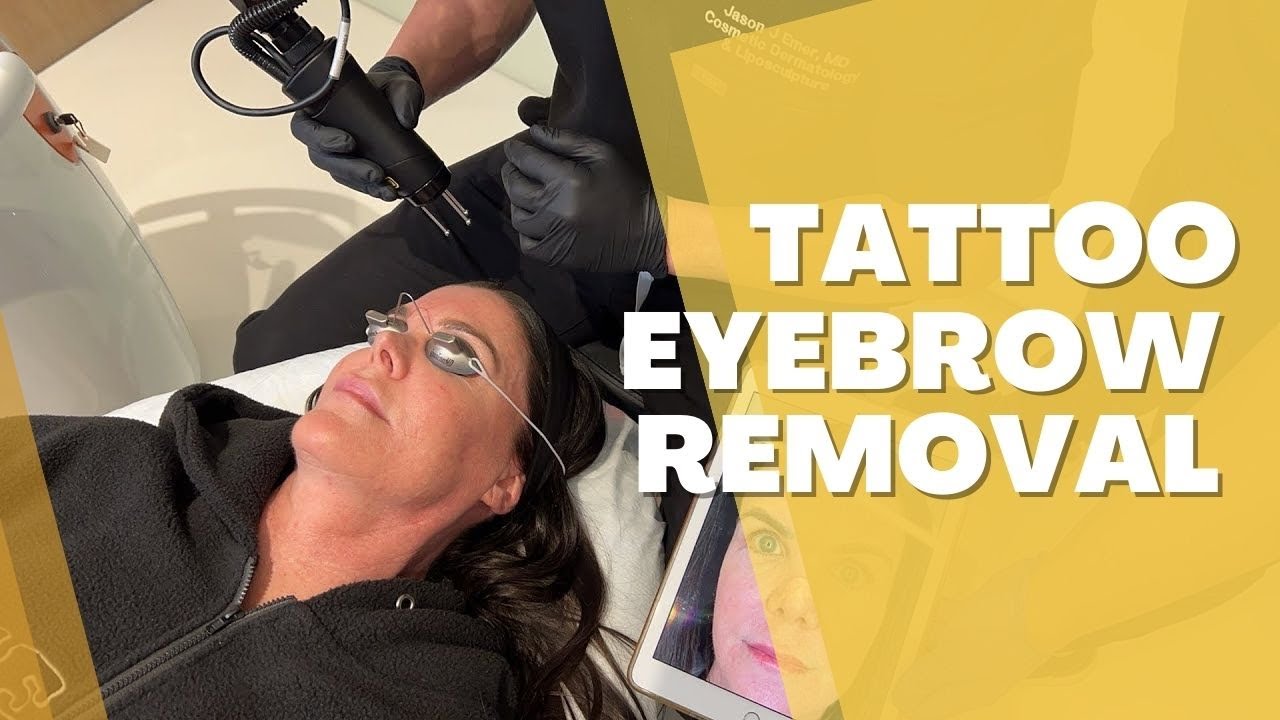 Astanza Ruby Laser For Tattoo Eyebrow Removal Dr Jason Emer Youtube
