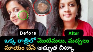 ఒక్క రాత్రిలో మొటిమలు,మచ్చలు మాయం | Home Remedy For Pimples | Get Rid Of Pigmentation | Dark Spots