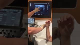 Dynamic wrist ultrasound of extensor carpi ulnaris (ECU) tendon to r/o subluxation or dislocation